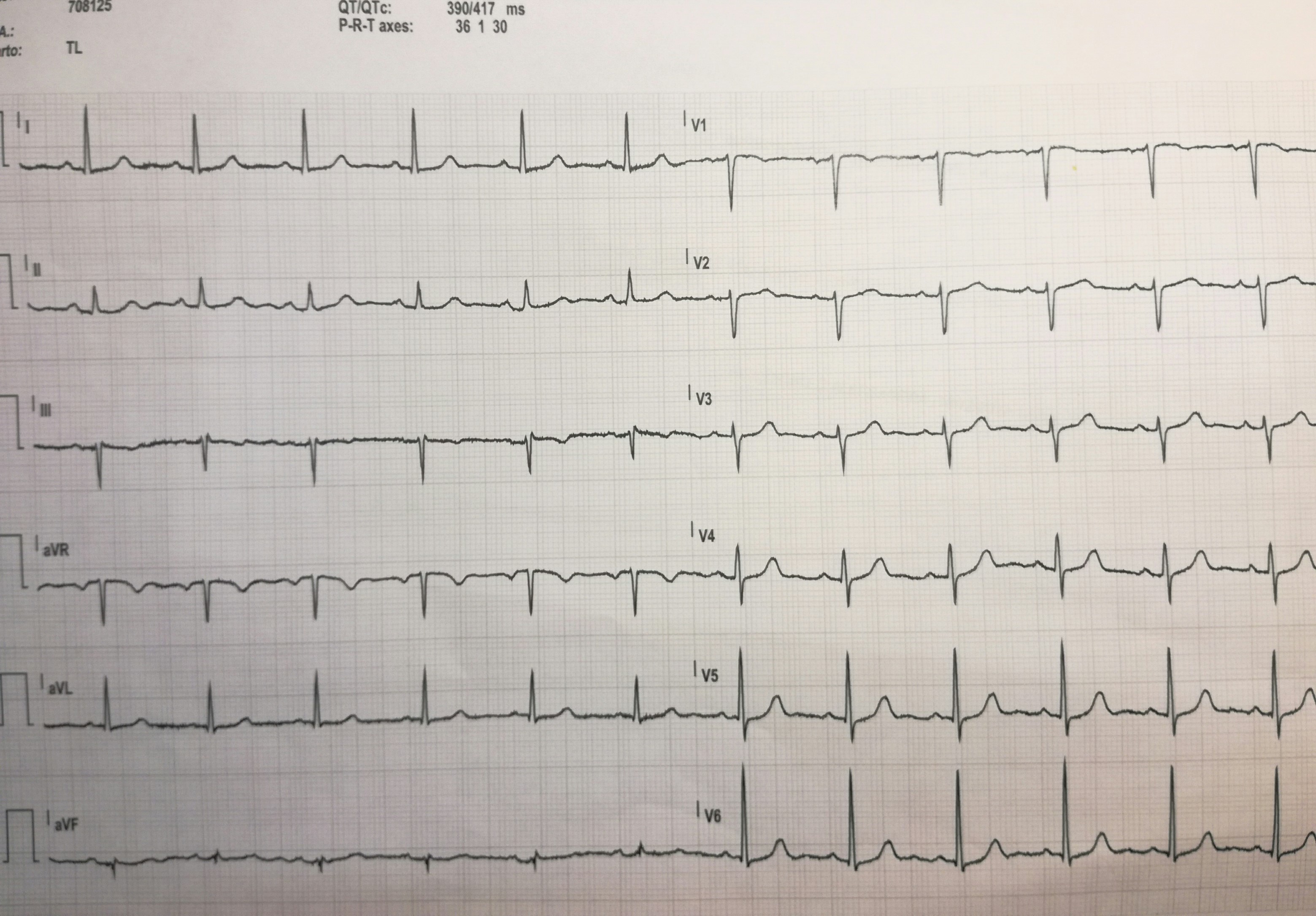 ecg_bs3