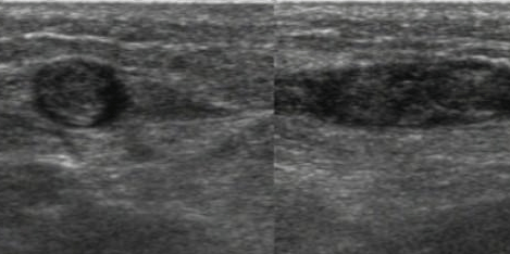 flebite-trombosi-venosa-superficiale-ecocolordoppler