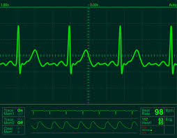 ECG monitor