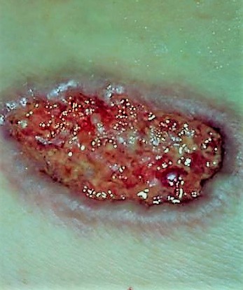 pioderma